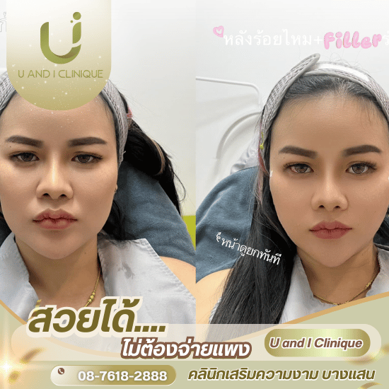 คลินิกร้อยไหมใกล้ฉัน บางแสน ศรีราชา ชลบุรี