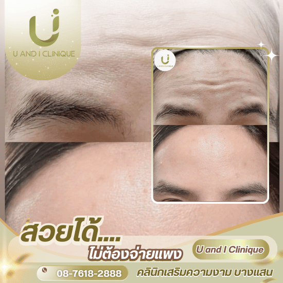 ฉีดโบลดริ้วรอย ชลบุรี - คลินิกเสริมความงาม บางแสน - ยูแอนด์ไอ คลินิก
