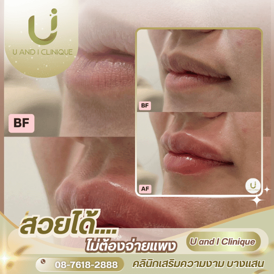 ฉีดฟิลเลอร์ปาก บางแสน ศรีราชา ชลบุรี ฉีดฟิลเลอร์ปาก บางแสน ศรีราชา ชลบุรี