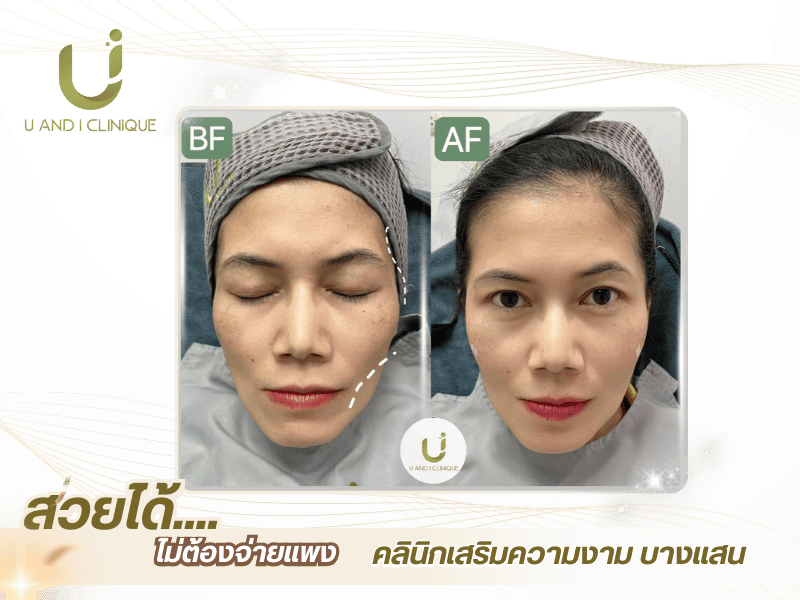 คลินิกฉีดฟิลเลอร์ ชลบุรี