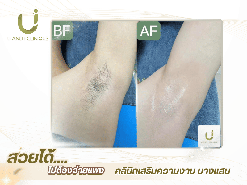 คลินิกเลเซอร์กำจัดขนใกล้ฉัน บางแสน-ศรีราชา ชลบุรี